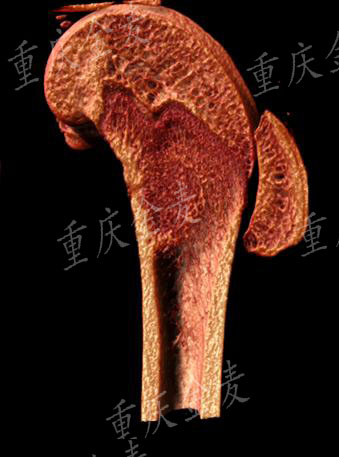 骨缺损模型4.jpg